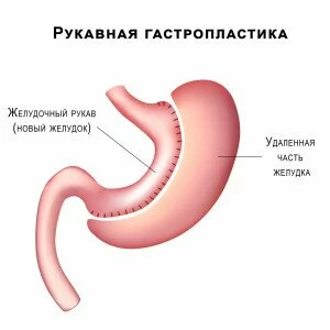 Laparoscopic-Sleeve-Gastrectomy